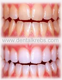 Blanqueamiento Dental