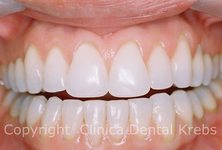 Blanqueamiento Dental