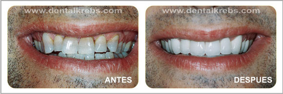 Carilla de Porcelana dental