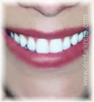 Blanqueamiento Dental con laser
