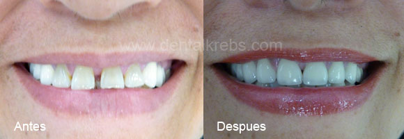 Lindos Dientes