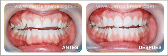 Diseño de la Sonrisa