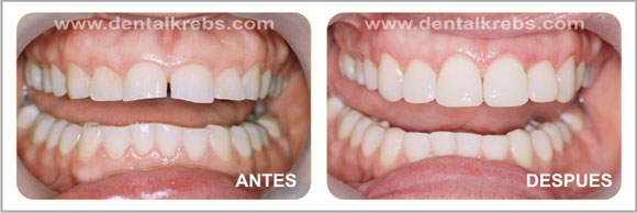 Diseño de la Sonrisa
