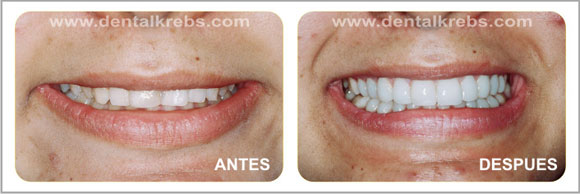 Diseño de la Sonrisa