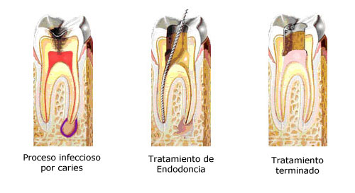 Endodoncia Dental