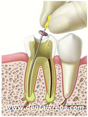 Endodoncia Tratamiento