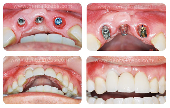 Implante Dientes