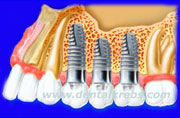 Implantes Dentales