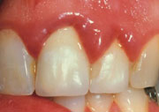 Periodoncia