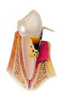 Periodoncia