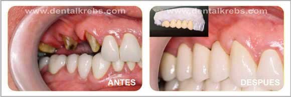 Coronas y Puentes de Porcelana