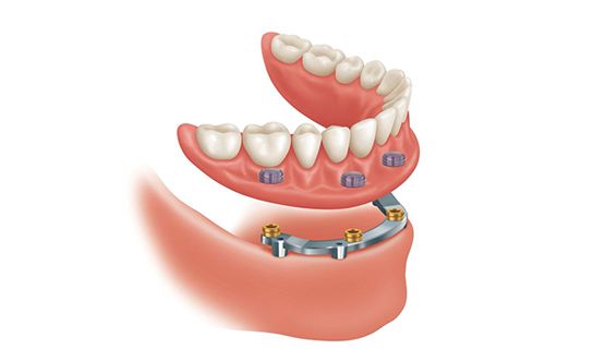 Sobre Dentadura Implantes