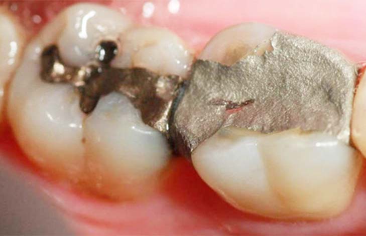 amalgama dental