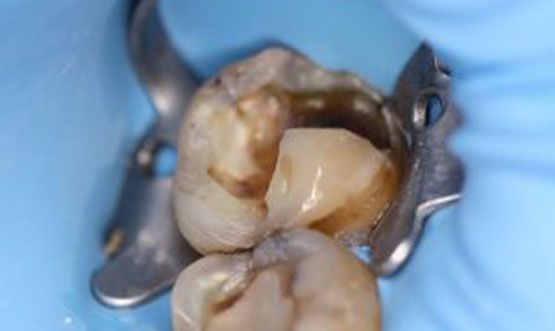 Dique de Goma Endodoncia