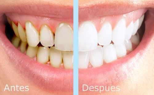 Blanqueamiento dental antes y despues