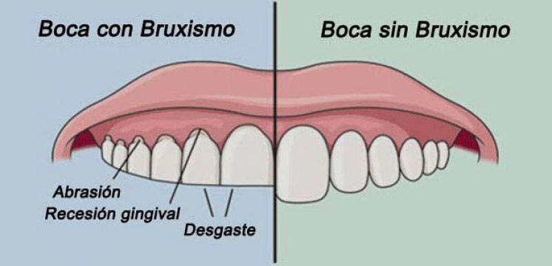 Solución al desgaste de los dientes por bruxismo