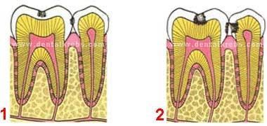 Caries Dental