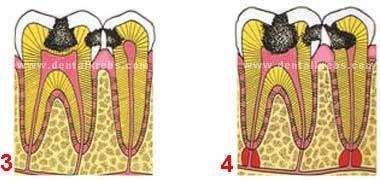 Caries en los Dientes