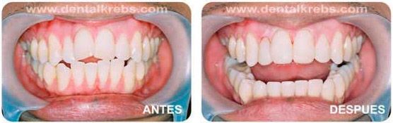 Arreglo de Dientes Desaliniados