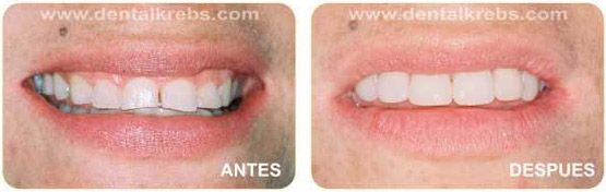 Correccion de Dientes desgastados