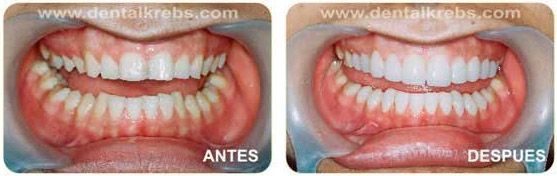 Recuperacion de Dientes Desgastados