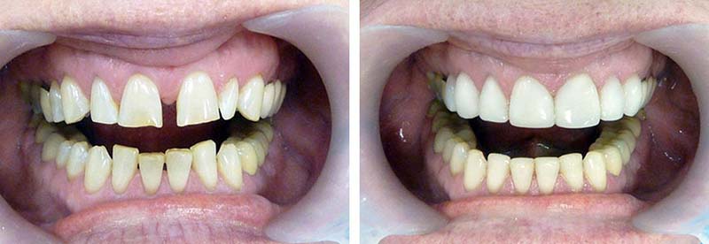 Qué son las carillas dentales y para qué sirven?