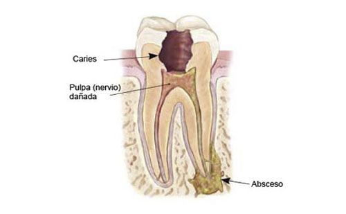 Por que Endodoncia