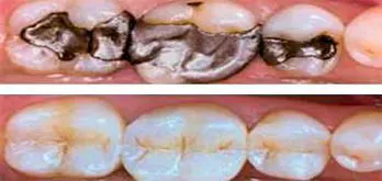 Curaciones Dentales esteticas