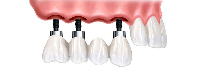 implantes dentales de titanio