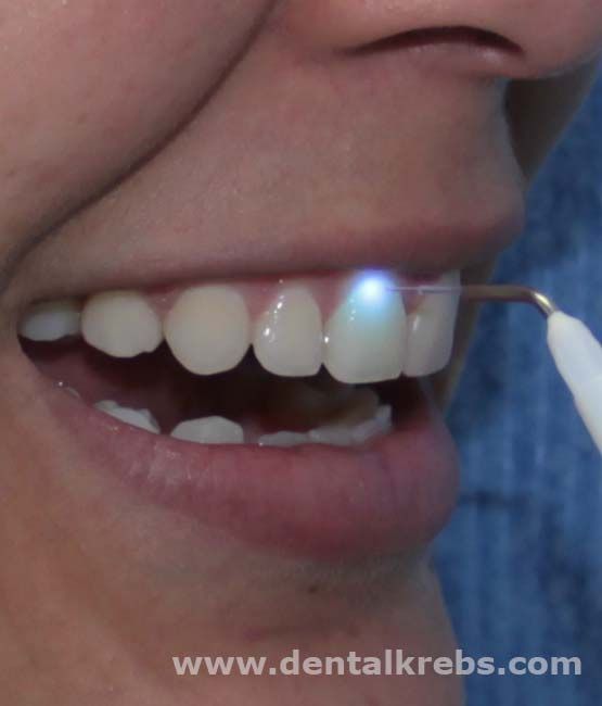 Dentista Laser