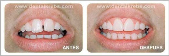 Diastema