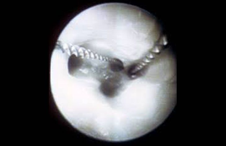 endodoncia con microscopio