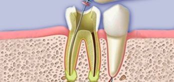 endodoncia