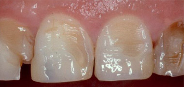 erosion dental