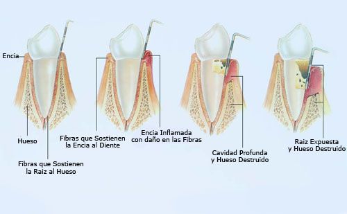 Estado Periodontal