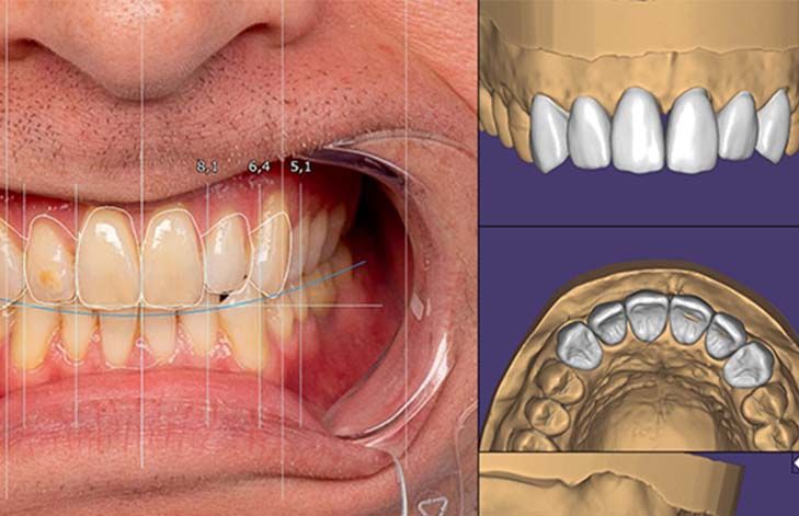 amalgama dental