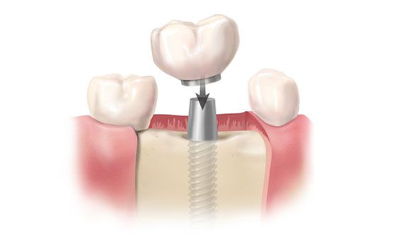 Dientes sobre implantes