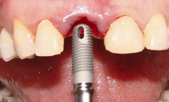 Implantes Dental Cirugia