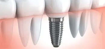 Implantes Dentales de titanio