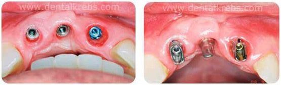 implantes dentales en boca