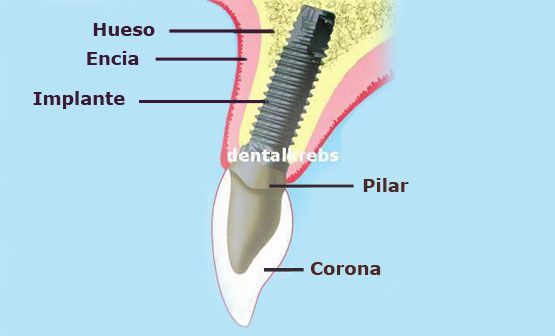 partes de un implante