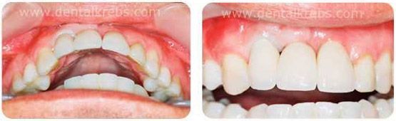 coronas sobre implantes dentales