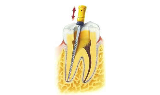 Endodoncia Instrumentacion