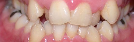 Ortodoncia Antes