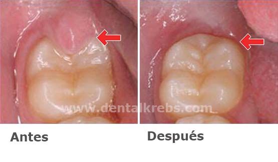 Pericoronitis Operculitis