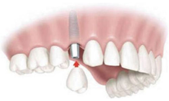 Protesis fija Implantes