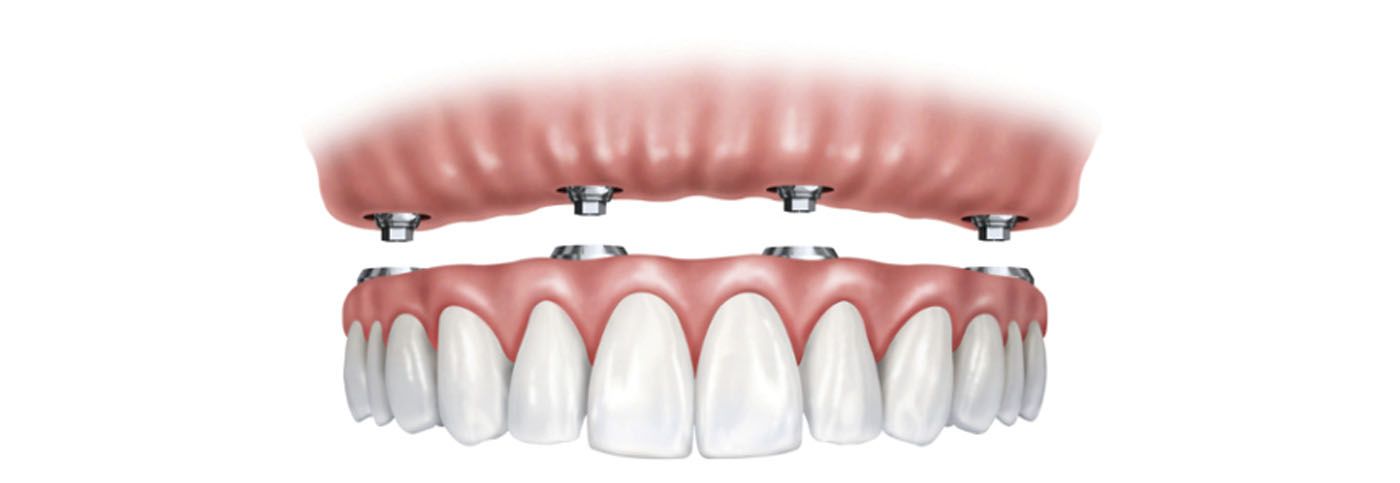 Tratamiento de Endodoncia