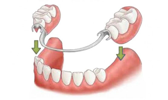 Protesis removible