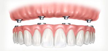 Protesis sobre Implantes