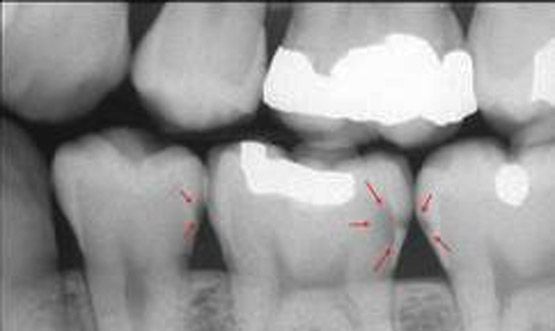 Radiografia Bite-Wing